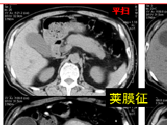 自身免疫性胰腺炎的影像学表现