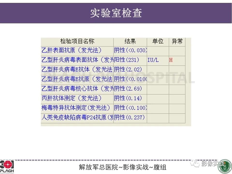 【病例】肝内胆管细胞癌1例MR影像-4