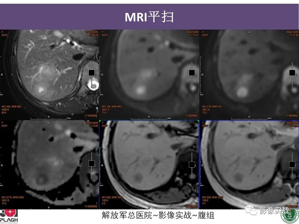 【病例】肝内胆管细胞癌1例MR影像-5