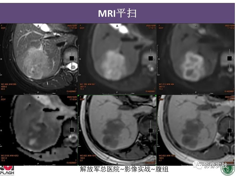 【病例】肝内胆管细胞癌1例MR影像-6