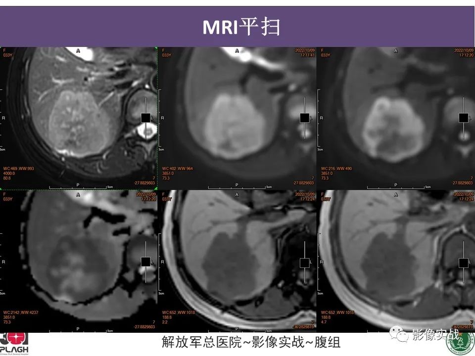 【病例】肝内胆管细胞癌1例MR影像-7