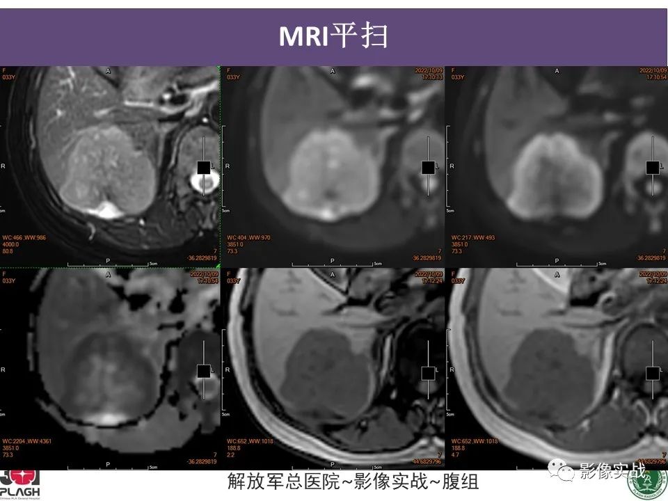【病例】肝内胆管细胞癌1例MR影像-8