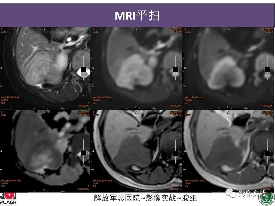 【病例】肝内胆管细胞癌1例MR影像-9