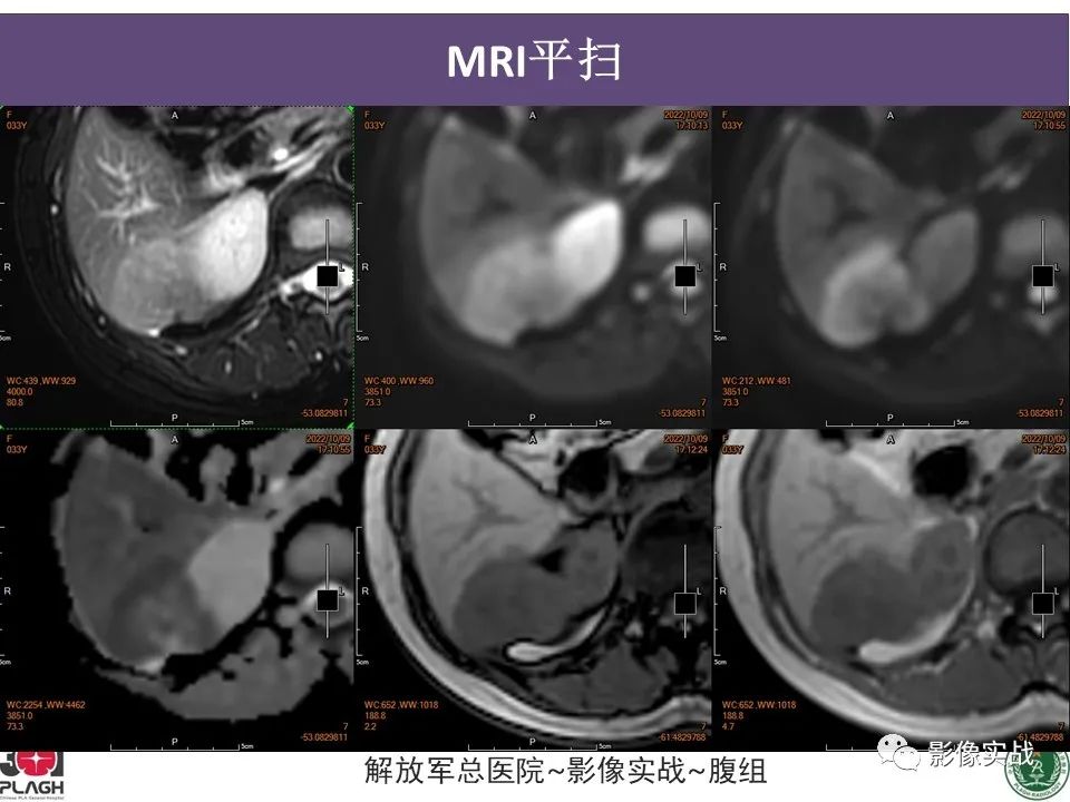 【病例】肝内胆管细胞癌1例MR影像-10