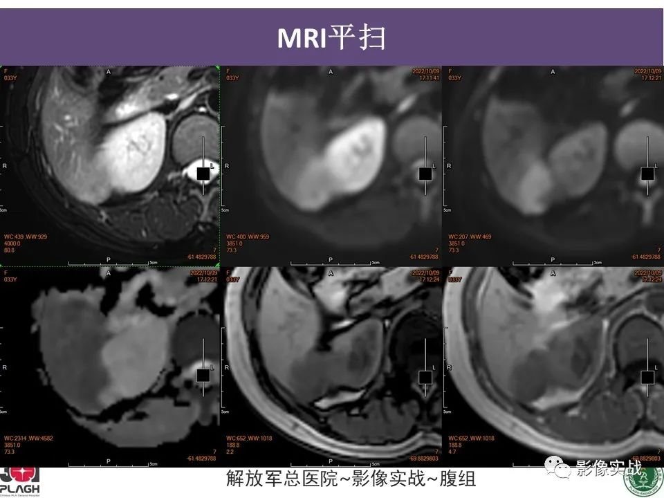 【病例】肝内胆管细胞癌1例MR影像-11