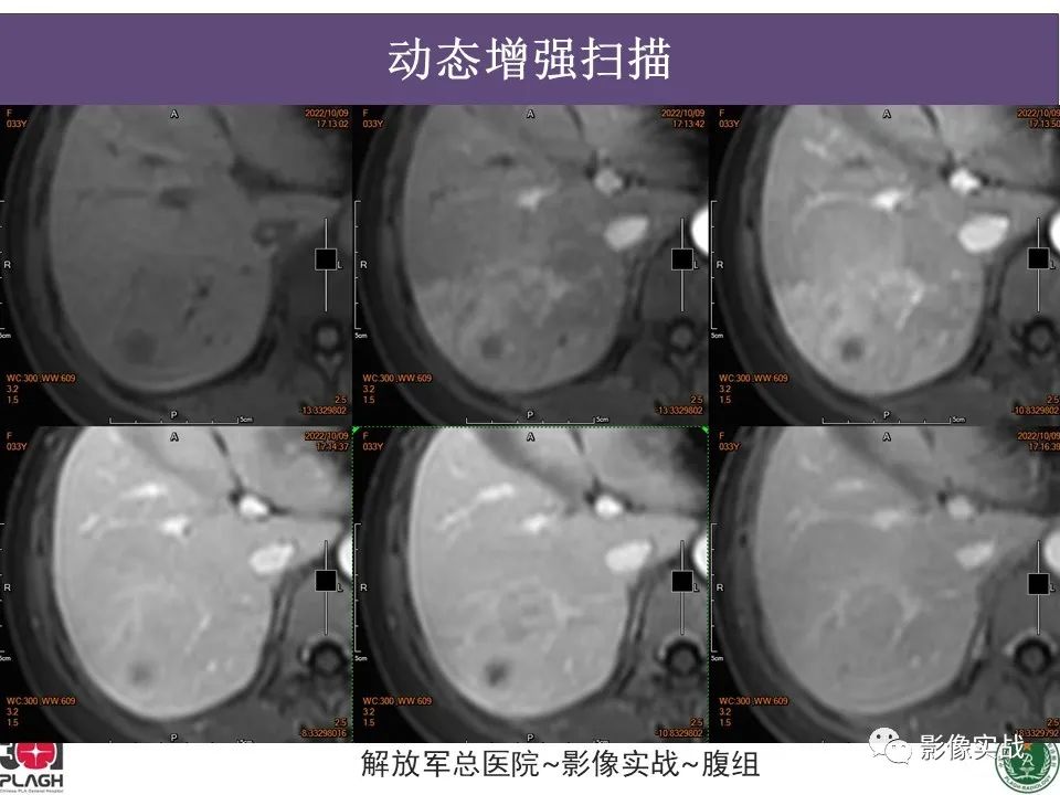 【病例】肝内胆管细胞癌1例MR影像-12