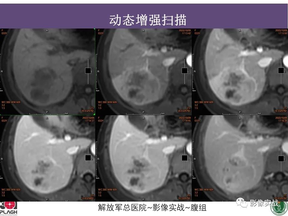 【病例】肝内胆管细胞癌1例MR影像-13