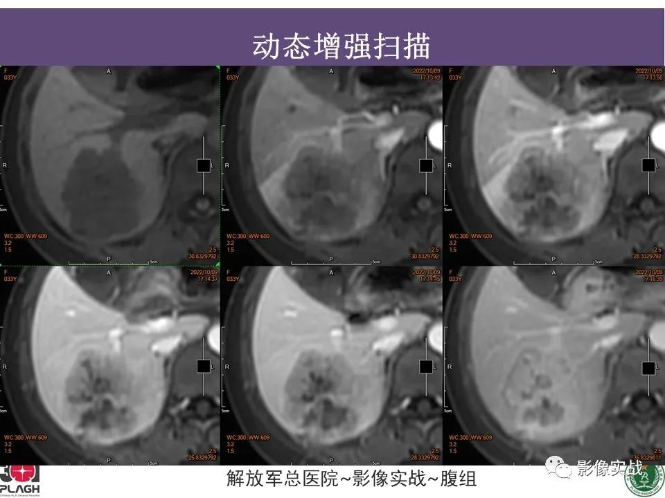 【病例】肝内胆管细胞癌1例MR影像-14