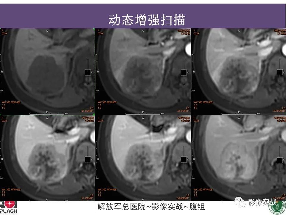 【病例】肝内胆管细胞癌1例MR影像-15