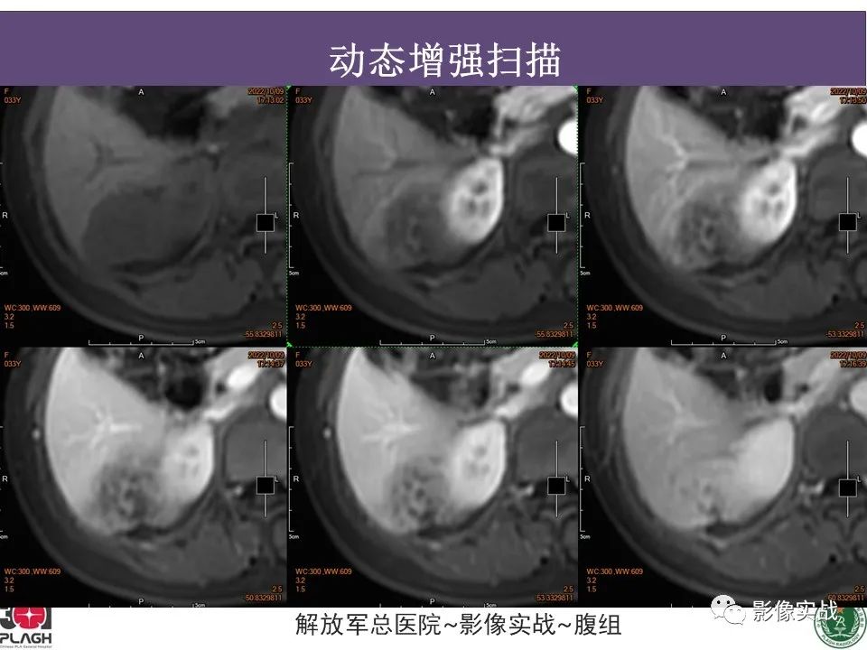 【病例】肝内胆管细胞癌1例MR影像-17