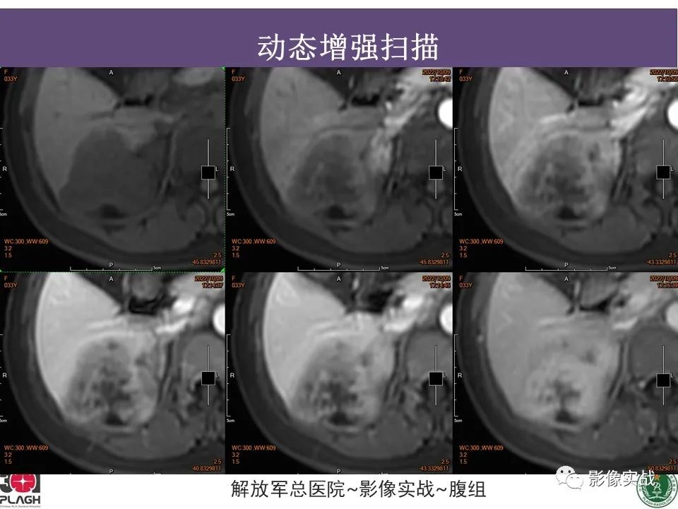 【病例】肝内胆管细胞癌1例MR影像-16