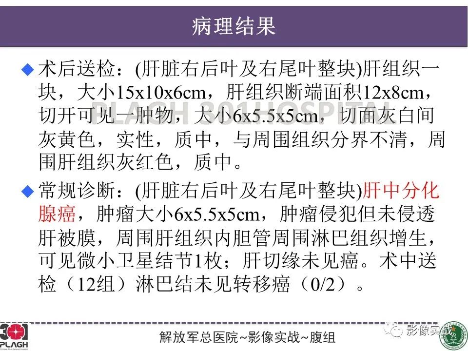 【病例】肝内胆管细胞癌1例MR影像-19