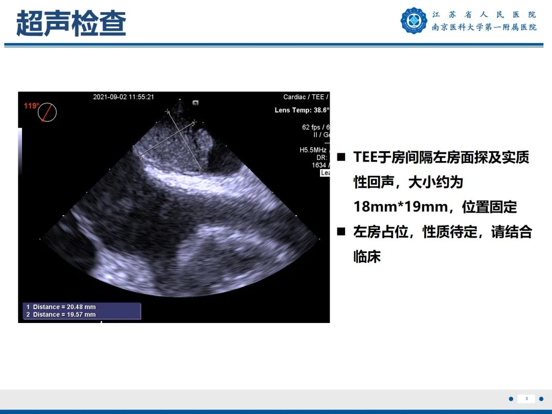 【PPT】心脏黏液瘤—心脏肿瘤MR评估-4