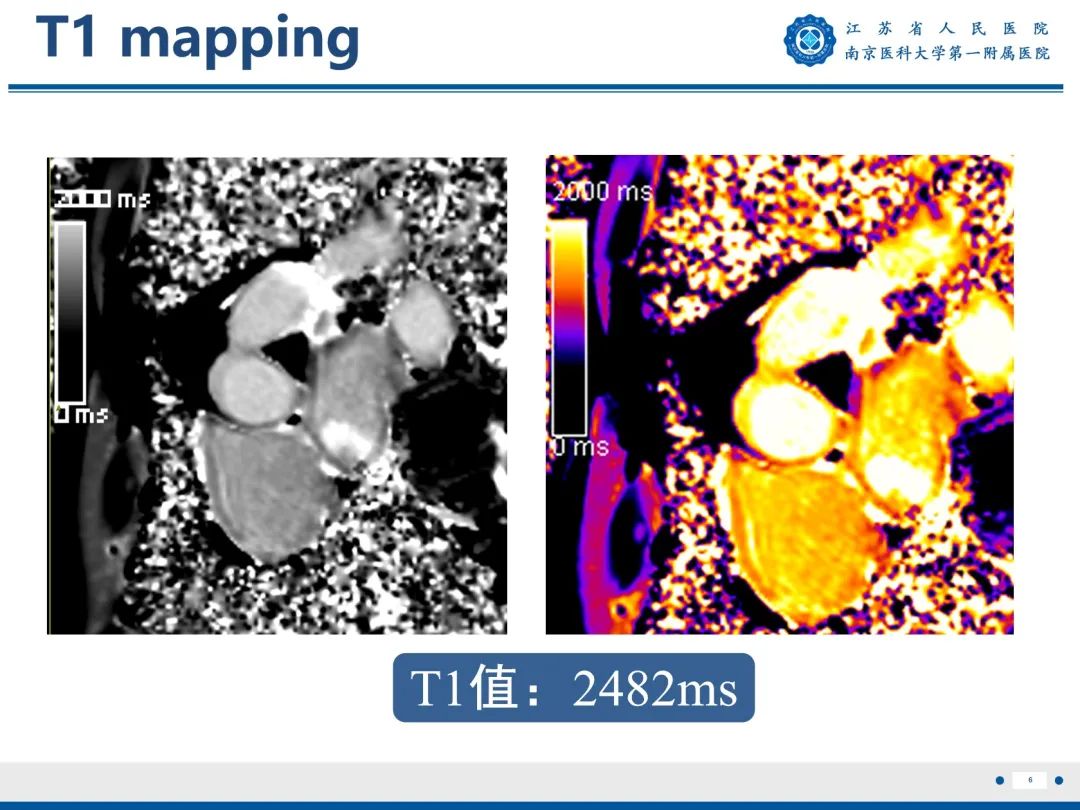 【PPT】心脏黏液瘤—心脏肿瘤MR评估-7