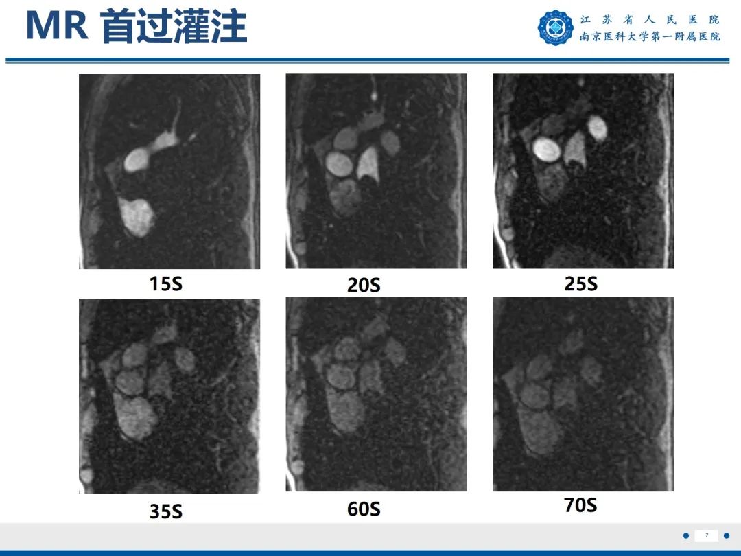 【PPT】心脏黏液瘤—心脏肿瘤MR评估-8