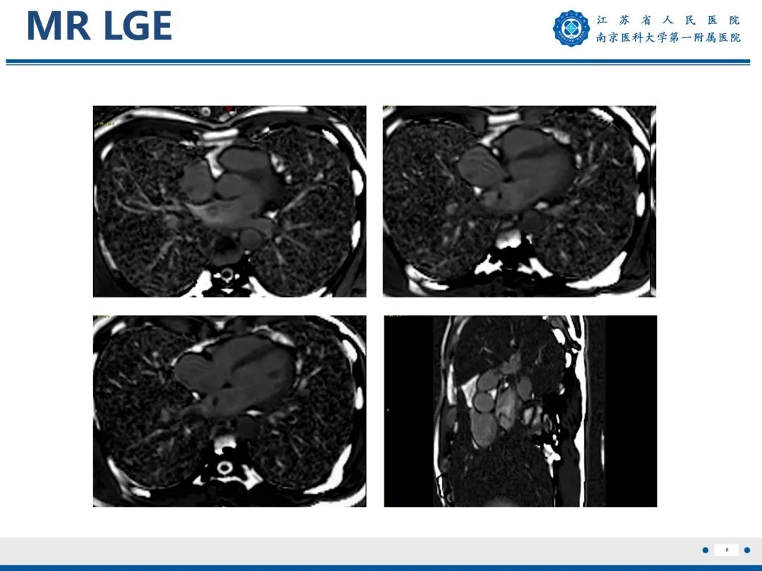 【PPT】心脏黏液瘤—心脏肿瘤MR评估-9
