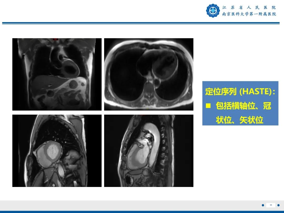 【PPT】心脏黏液瘤—心脏肿瘤MR评估-12