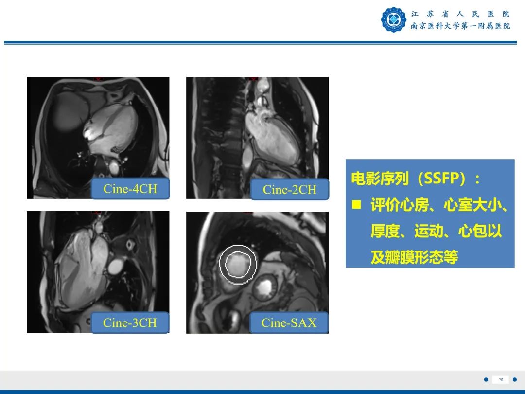 【PPT】心脏黏液瘤—心脏肿瘤MR评估-13