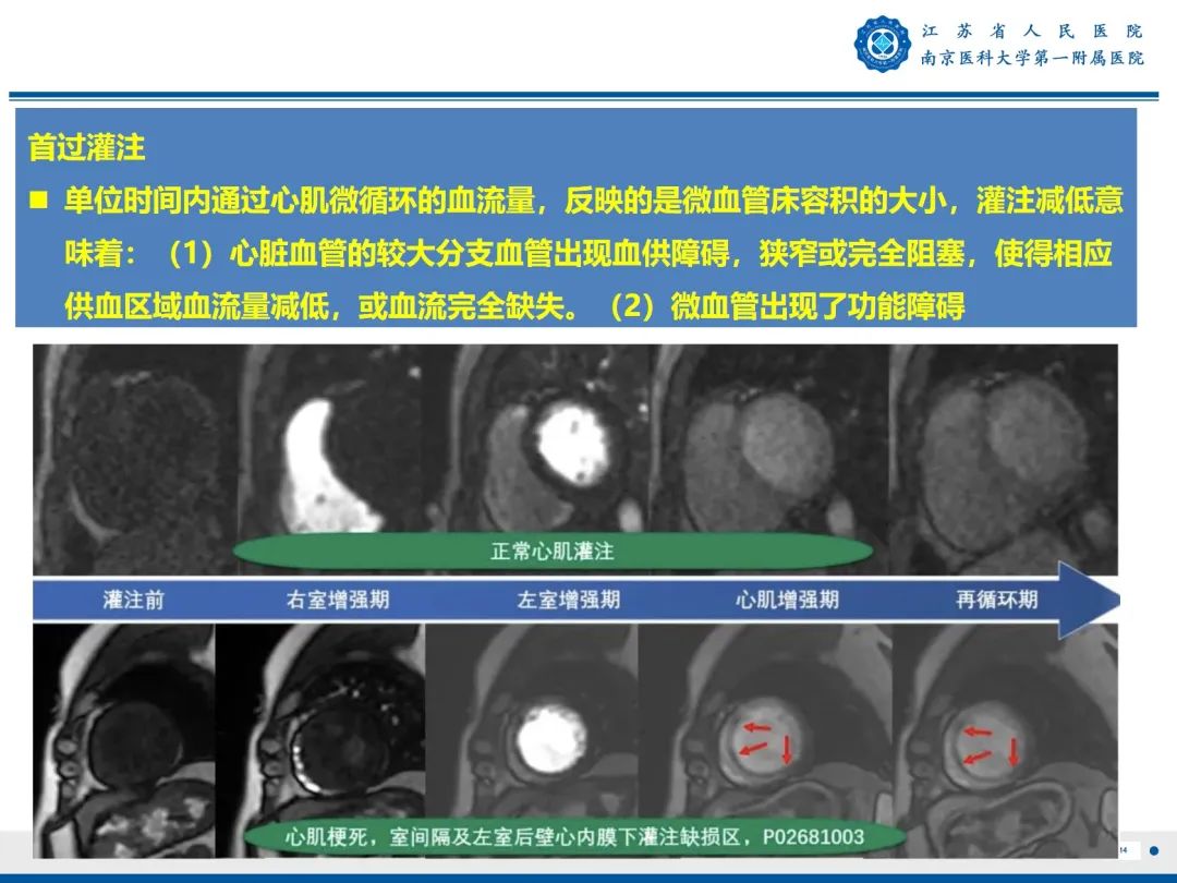 【PPT】心脏黏液瘤—心脏肿瘤MR评估-15