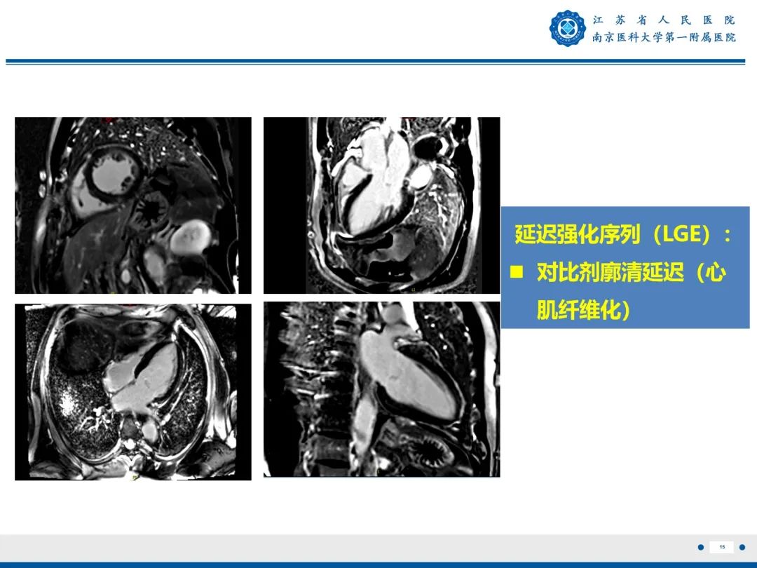 【PPT】心脏黏液瘤—心脏肿瘤MR评估-16