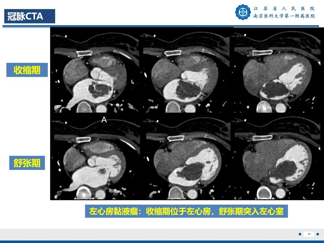 【PPT】心脏黏液瘤—心脏肿瘤MR评估-27