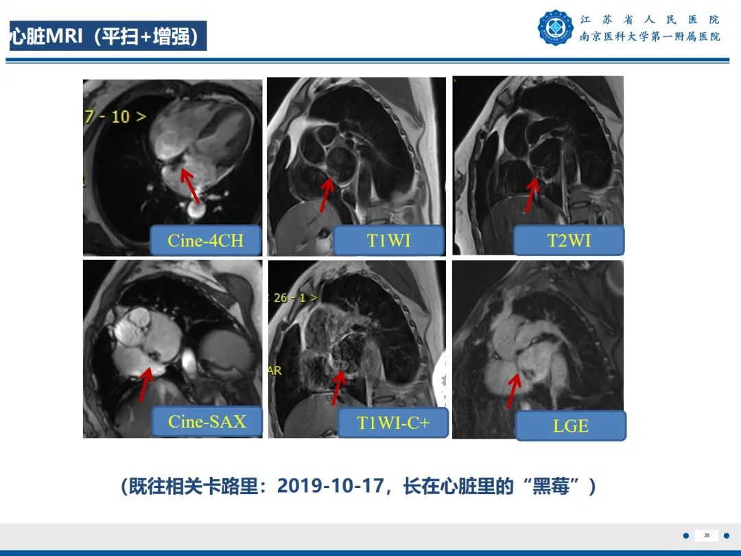 【PPT】心脏黏液瘤—心脏肿瘤MR评估-29