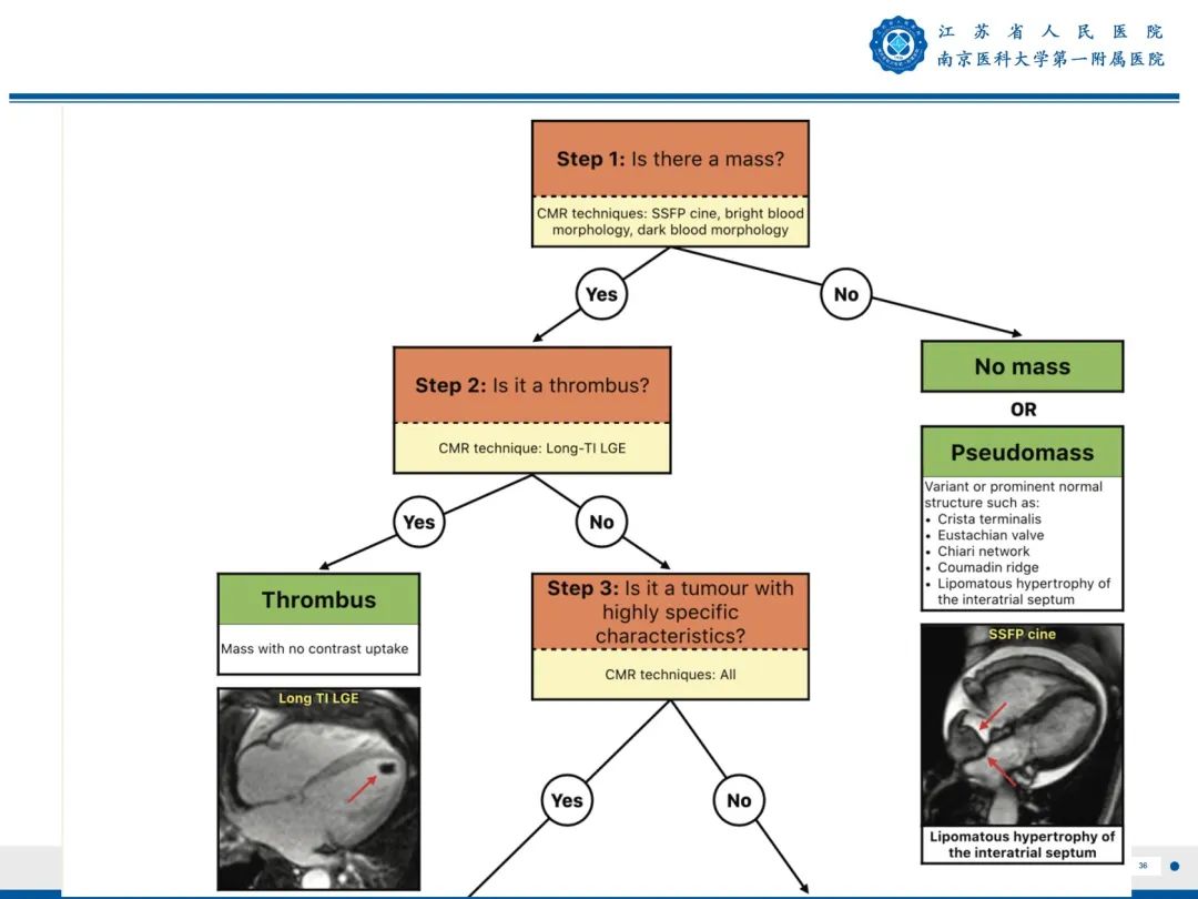 【PPT】心脏黏液瘤—心脏肿瘤MR评估-37