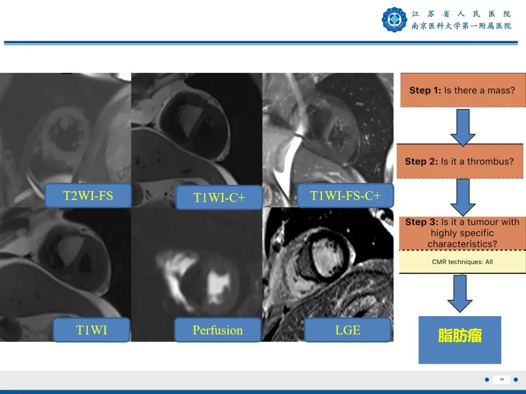 【PPT】心脏黏液瘤—心脏肿瘤MR评估-40