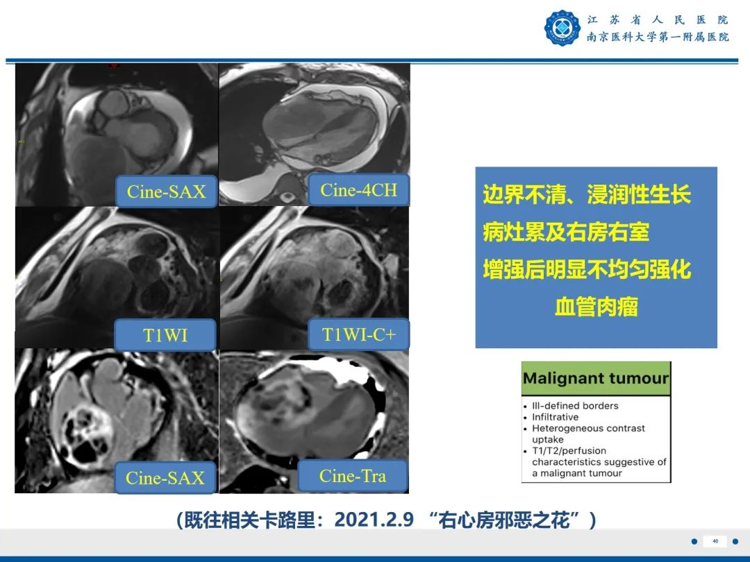 【PPT】心脏黏液瘤—心脏肿瘤MR评估-41