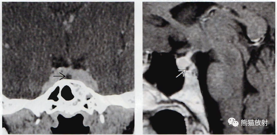垂体微腺瘤、垂体大腺瘤影像诊断要点-4 垂体微腺瘤、垂体大腺瘤影像诊断要点-4