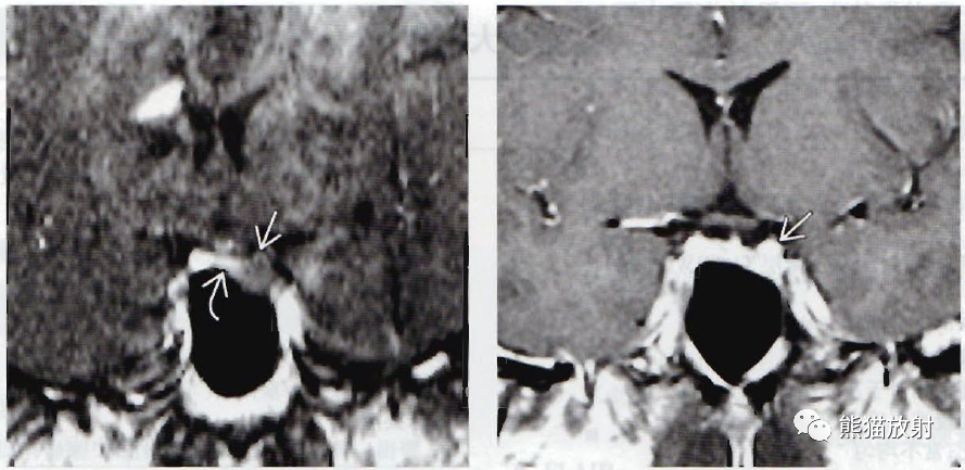 垂体微腺瘤、垂体大腺瘤影像诊断要点-3 垂体微腺瘤、垂体大腺瘤影像诊断要点-3