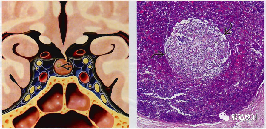 垂体微腺瘤、垂体大腺瘤影像诊断要点-1 垂体微腺瘤、垂体大腺瘤影像诊断要点-1