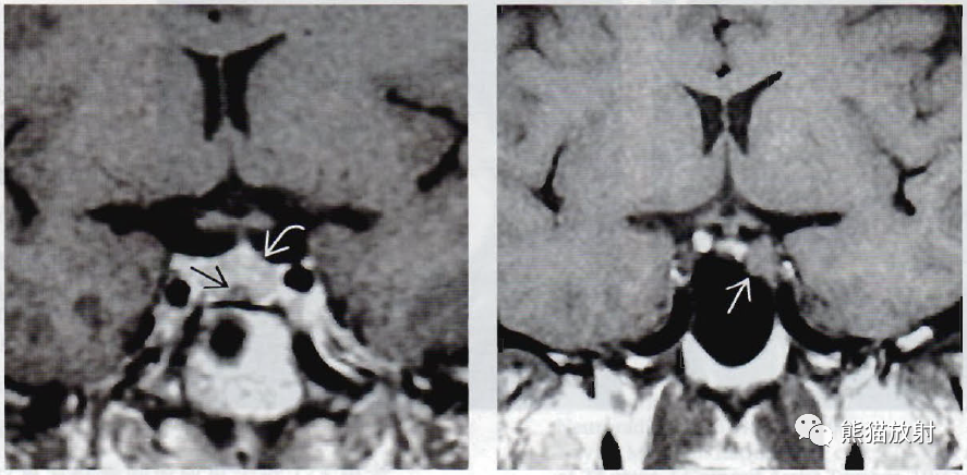 垂体微腺瘤、垂体大腺瘤影像诊断要点-2 垂体微腺瘤、垂体大腺瘤影像诊断要点-2