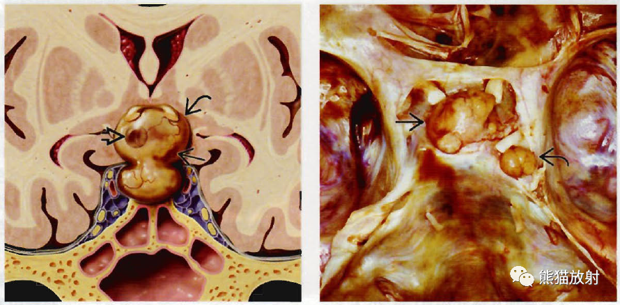垂体微腺瘤、垂体大腺瘤影像诊断要点-5 垂体微腺瘤、垂体大腺瘤影像诊断要点-5