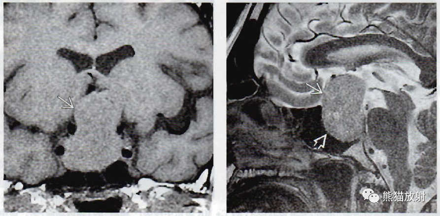 垂体微腺瘤、垂体大腺瘤影像诊断要点-6 垂体微腺瘤、垂体大腺瘤影像诊断要点-6