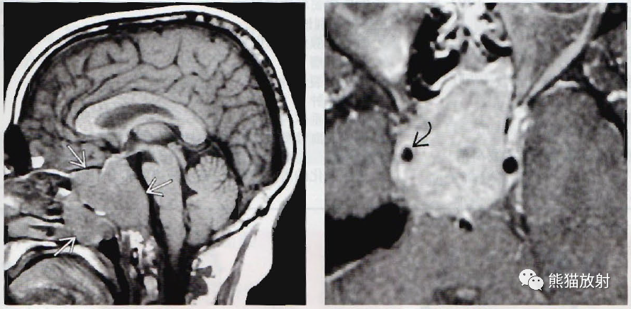 垂体微腺瘤、垂体大腺瘤影像诊断要点-7 垂体微腺瘤、垂体大腺瘤影像诊断要点-7