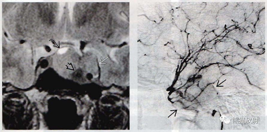 垂体微腺瘤、垂体大腺瘤影像诊断要点-8 垂体微腺瘤、垂体大腺瘤影像诊断要点-8