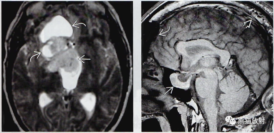 垂体微腺瘤、垂体大腺瘤影像诊断要点-9 垂体微腺瘤、垂体大腺瘤影像诊断要点-9