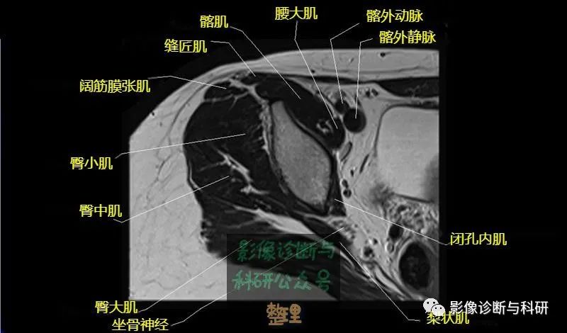 髋关节MR轴位详细标注-5 髋关节MR轴位详细标注-5