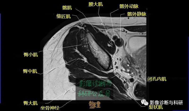 髋关节MR轴位详细标注-3 髋关节MR轴位详细标注-3