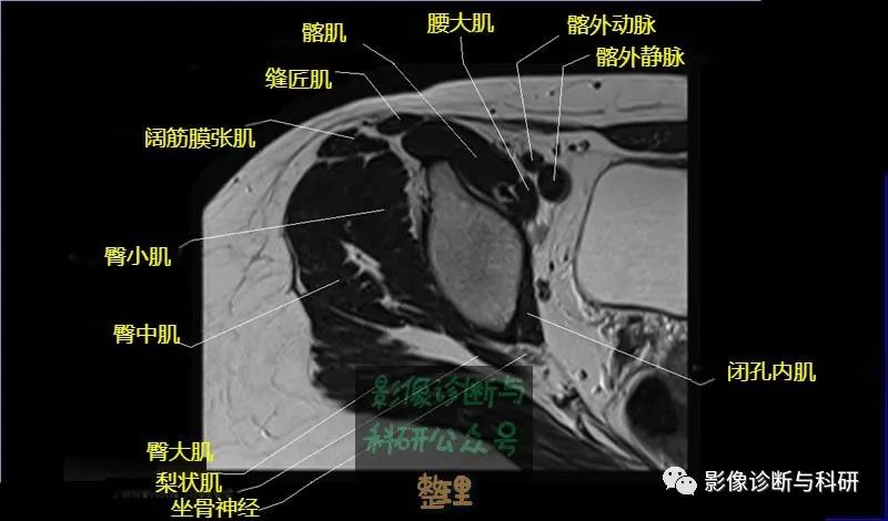 髋关节MR轴位详细标注-6 髋关节MR轴位详细标注-6