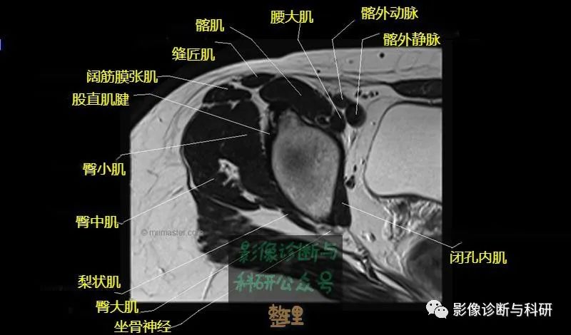 髋关节MR轴位详细标注-7 髋关节MR轴位详细标注-7