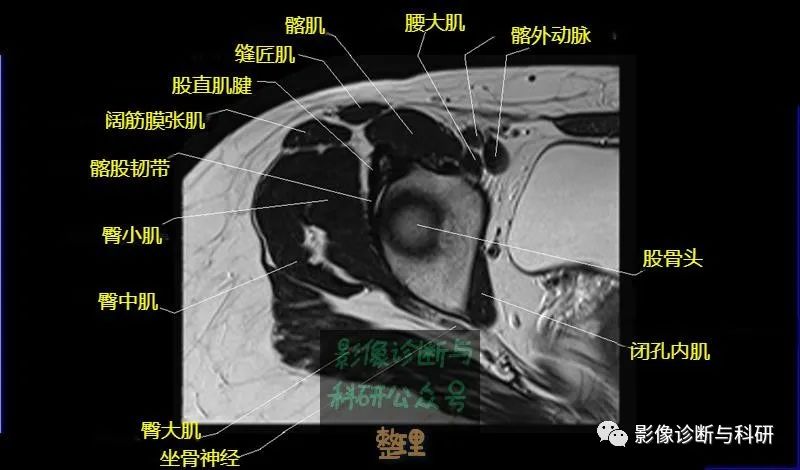 髋关节MR轴位详细标注-8 髋关节MR轴位详细标注-8