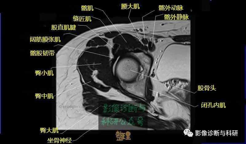 髋关节MR轴位详细标注-9 髋关节MR轴位详细标注-9