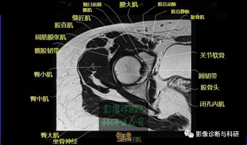 髋关节MR轴位详细标注-10 髋关节MR轴位详细标注-10