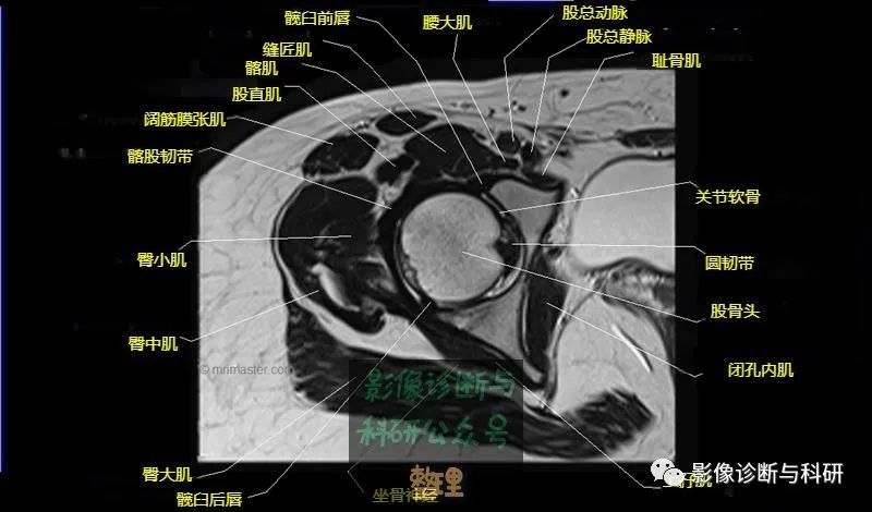 髋关节MR轴位详细标注-11 髋关节MR轴位详细标注-11