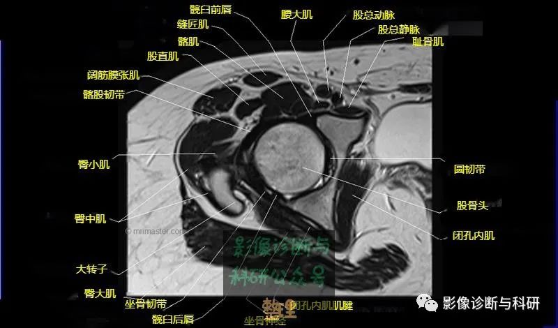 髋关节MR轴位详细标注-12 髋关节MR轴位详细标注-12