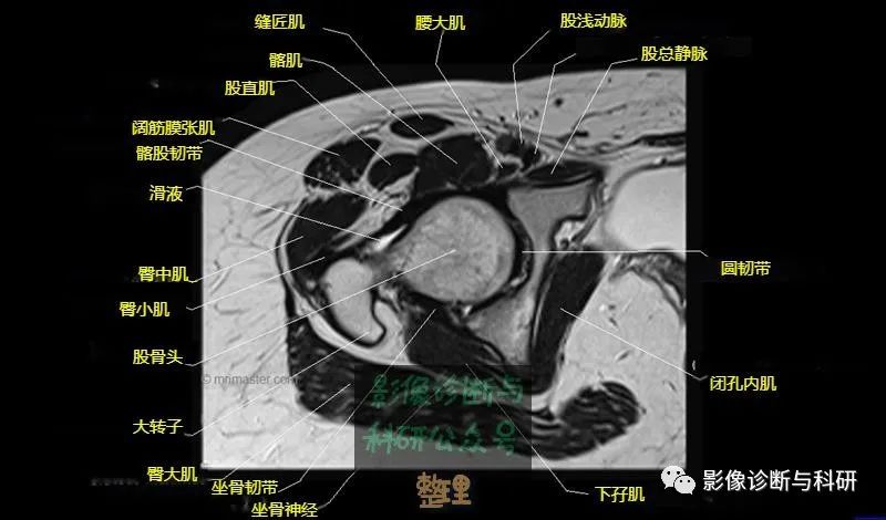 髋关节MR轴位详细标注-13 髋关节MR轴位详细标注-13