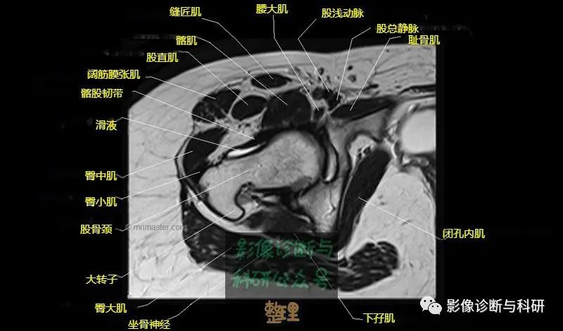 髋关节MR轴位详细标注-14 髋关节MR轴位详细标注-14