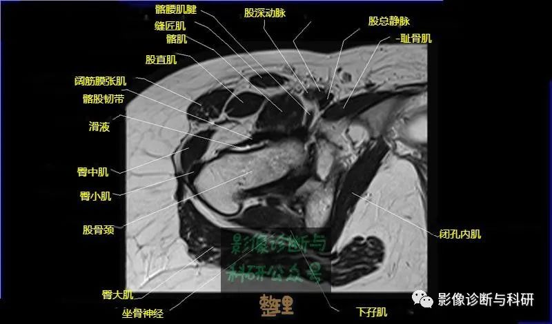 髋关节MR轴位详细标注-15 髋关节MR轴位详细标注-15